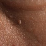 Genital Siğil Kremi: Sağlığınız İçin Bilmeniz Gerekenler ve Doğru Kullanım İpuçları